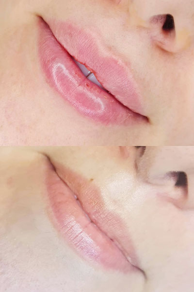 lip-filler (1)