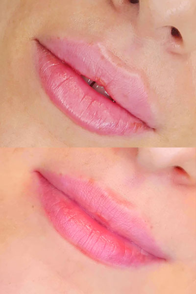 lip-filler-2