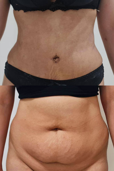 Abdominoplasty-befroe-after