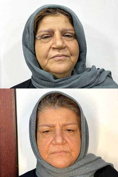 Blepharoplasty2