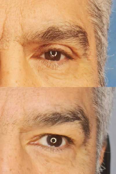 Blepharoplasty4