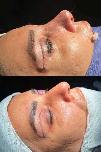 rhinoplasty