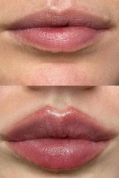 lip-filler1