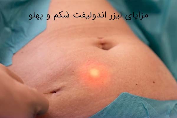 اندولیفت شکم و پهلو