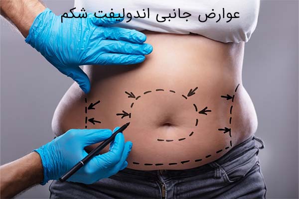 اندولیفت شکم و پهلو