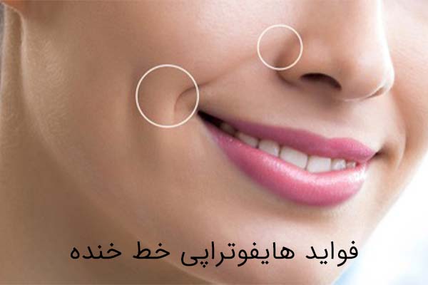 فواید هایفوتراپی خط خنده