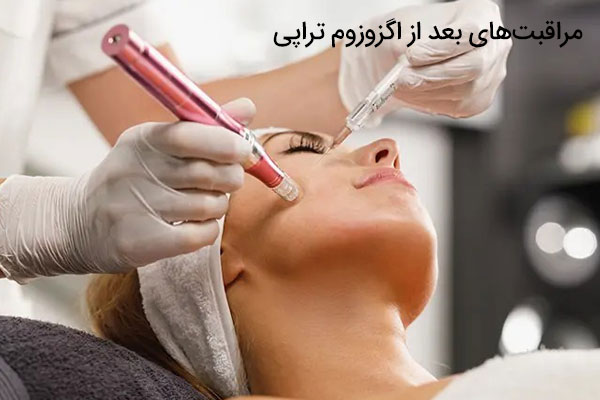 مراقبت‌های بعد از اگزوزوم تراپی