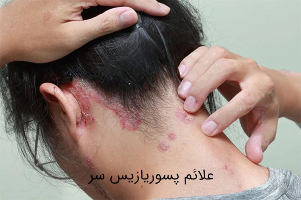 روش های درمان پسوریازیس