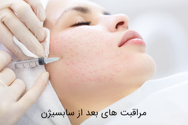 مراقبت های بعد از سابسیژن