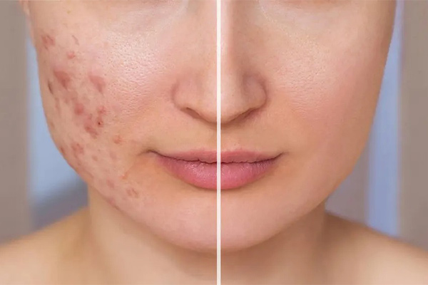 مراقبت های بعد از سابسیژن