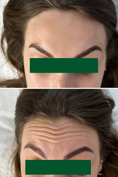 بوتاکس پیشانی