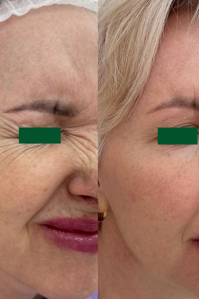 بوتاکس پیشانی