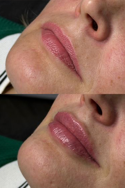 lip-filler1-1 (1)