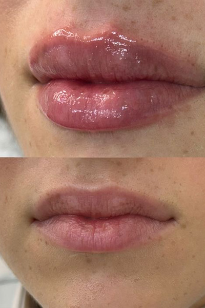 lip-filler122