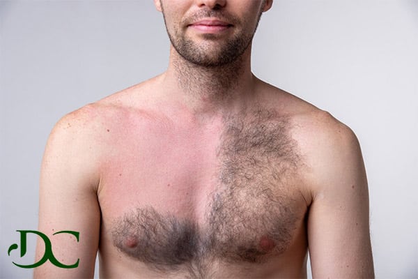 لیزر موهای سینه و اطراف آن برای آقایان و بانوان