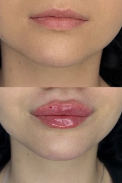 lip-filler4