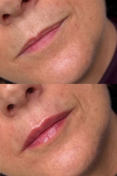 lip-filler5