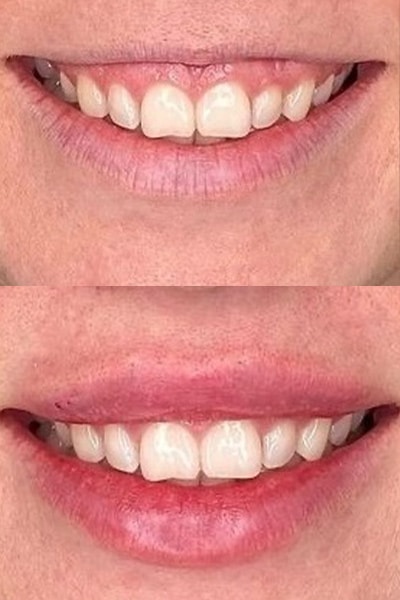 lip-filler6