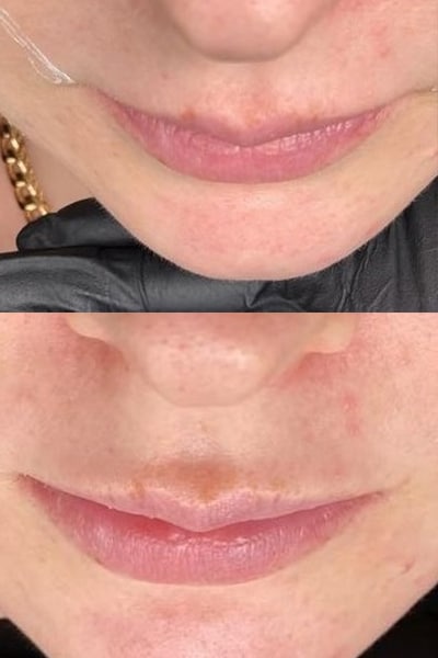 lip-filler7