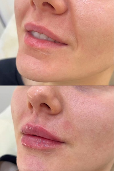 lip-filler8