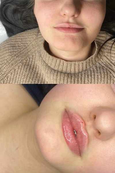 lip-filler9
